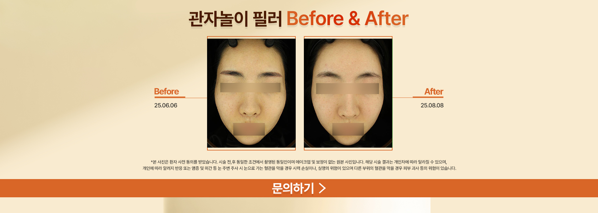 관자놀이