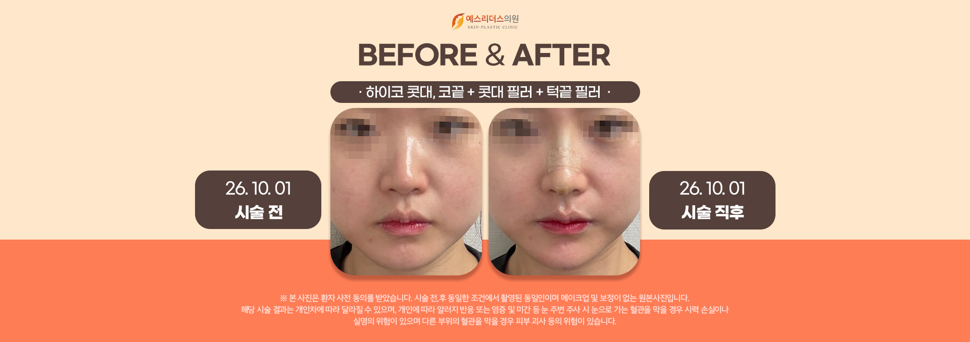 하이코 전후